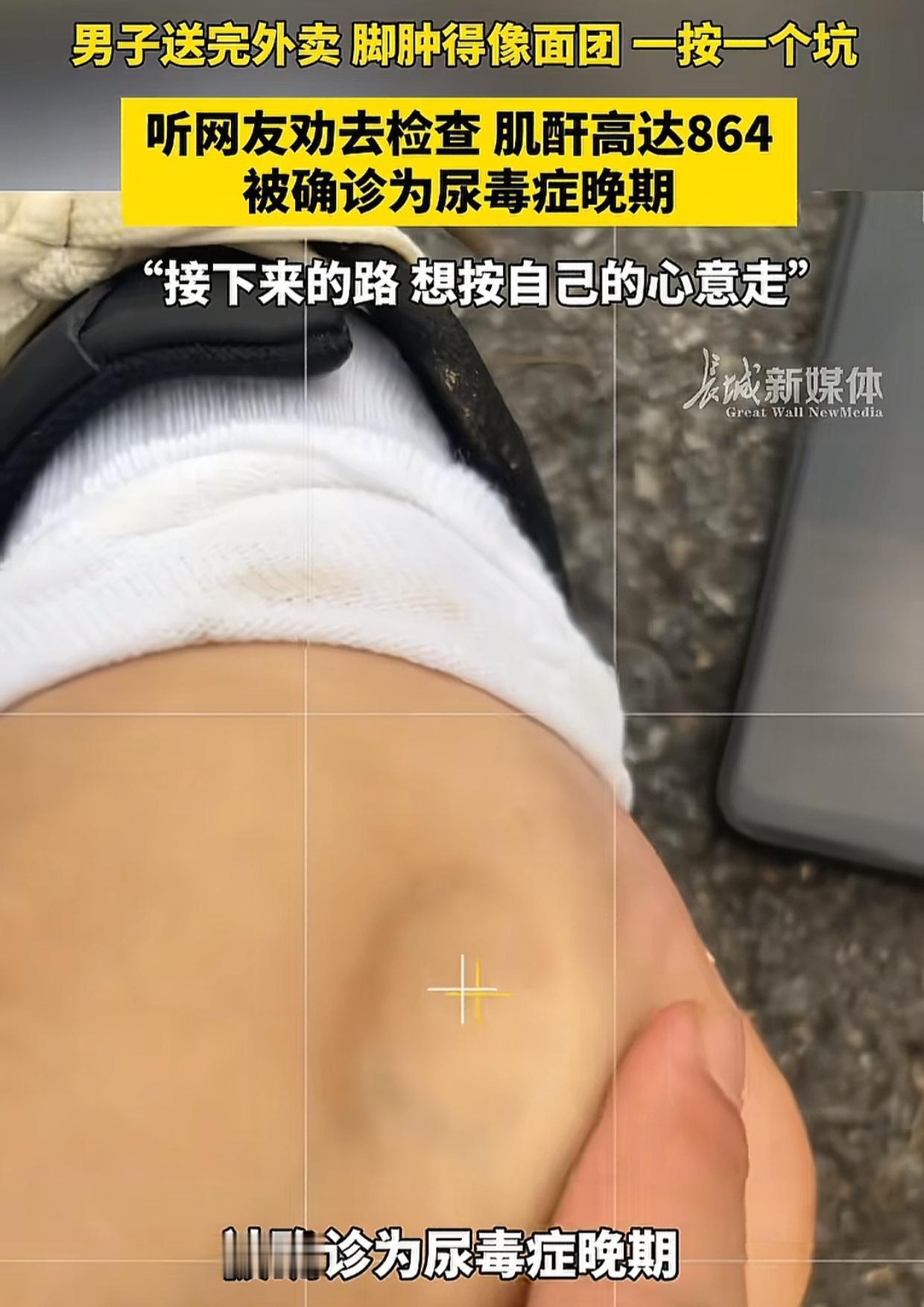 广东一名男子，送外卖后回来发现自己的脚肿了，一摁一个坑，他觉得很奇怪，就随手拍了