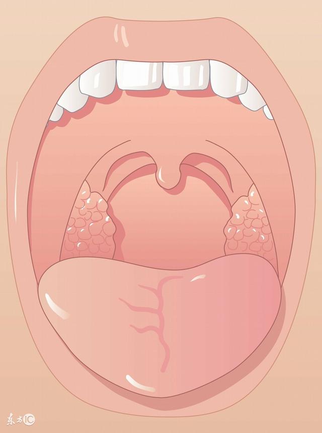 扁桃体与肾炎之间的那些事儿