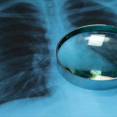 关于特发性肺纤维化新药奈米司特全部信息（三）——药物疗效对比奈米司特vs