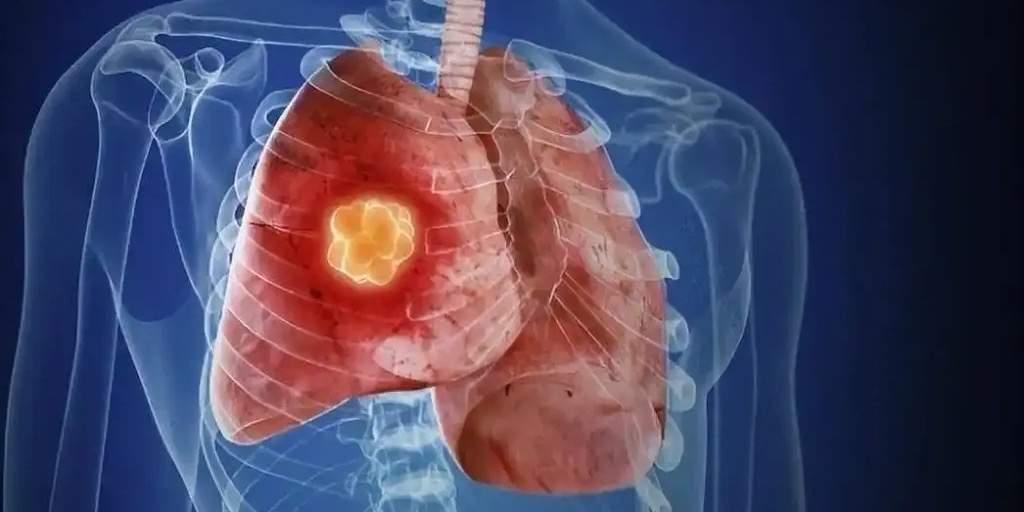 谁能想到？母亲肺癌手术住院，儿子贴身陪护半个月，自己居然也查出了肺癌！这事