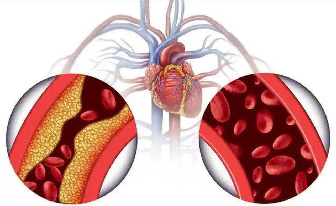 低密度蛋白超过这个“安全线”，或引起3个并发症！医生一文说清 你可能觉得自己