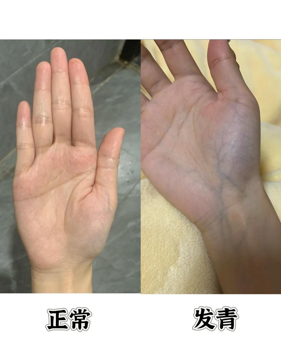 大鱼际发青是不对的，解答粉丝留言的问题。临床我就发现有咳嗽的小患者，仔细一看手