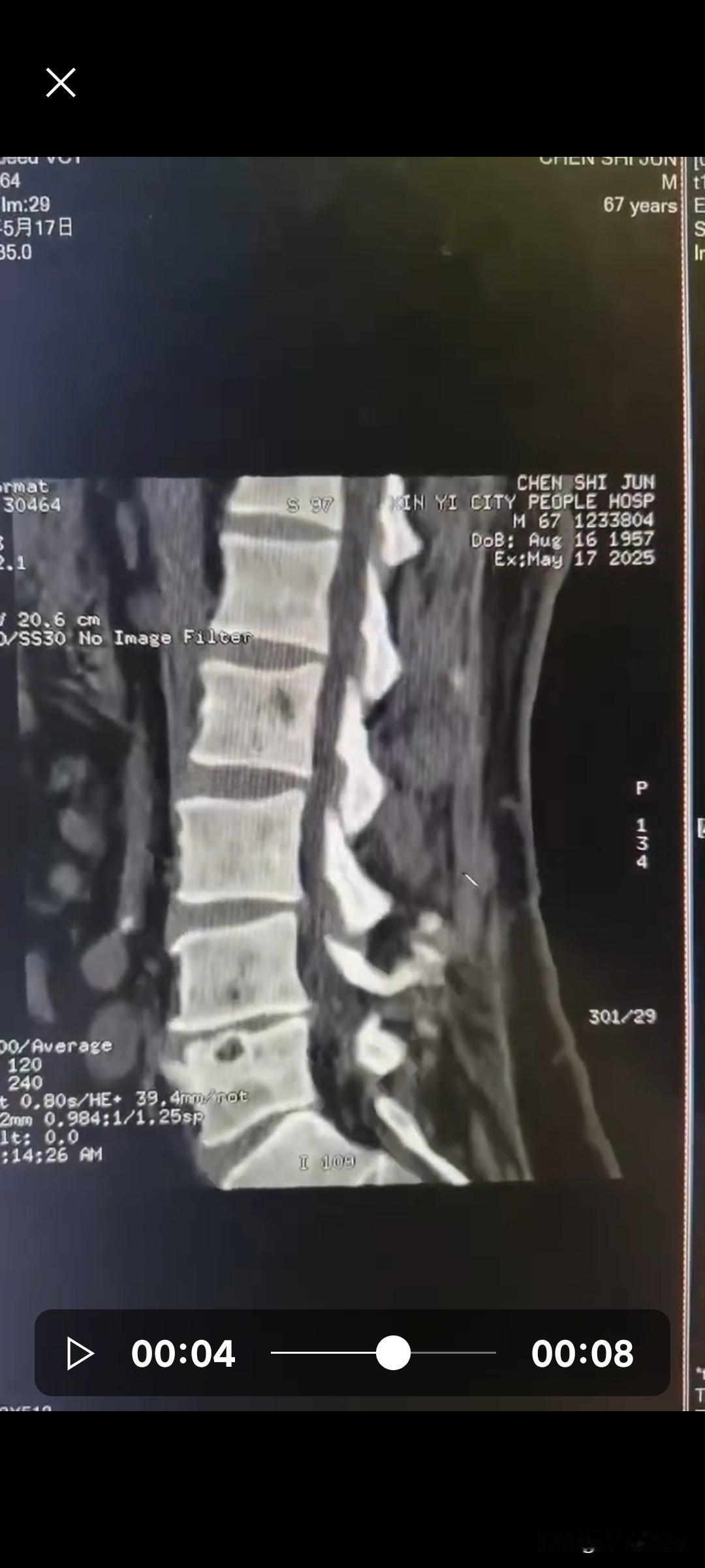 我乡下有个本家亲戚，在县医院查出腰椎间盘突出，需要做手术治疗。科室主任跟他说：“