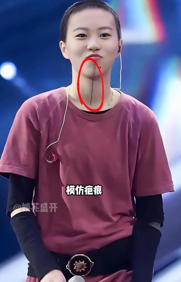 李嫣的嘴唇愈合那天，窦靖童下巴的“伤疤”也悄悄消失了。你以为那是一道叛逆的黑线