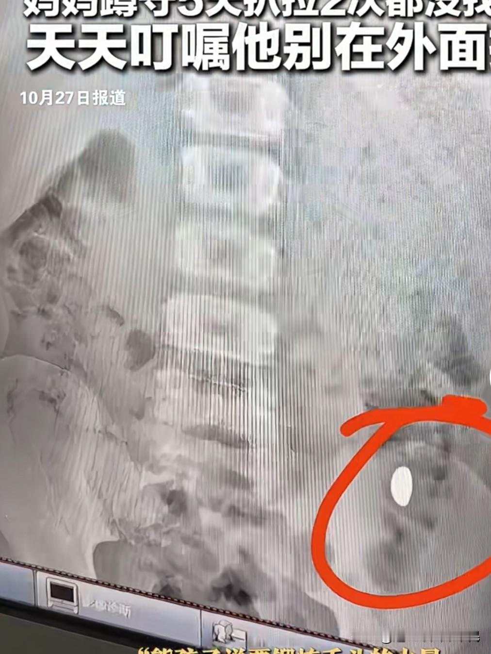 小孩哥脑回路清奇,为了锻炼舌头把家里10克的黄金豆放到嘴巴里,谁知一不小心给吞到