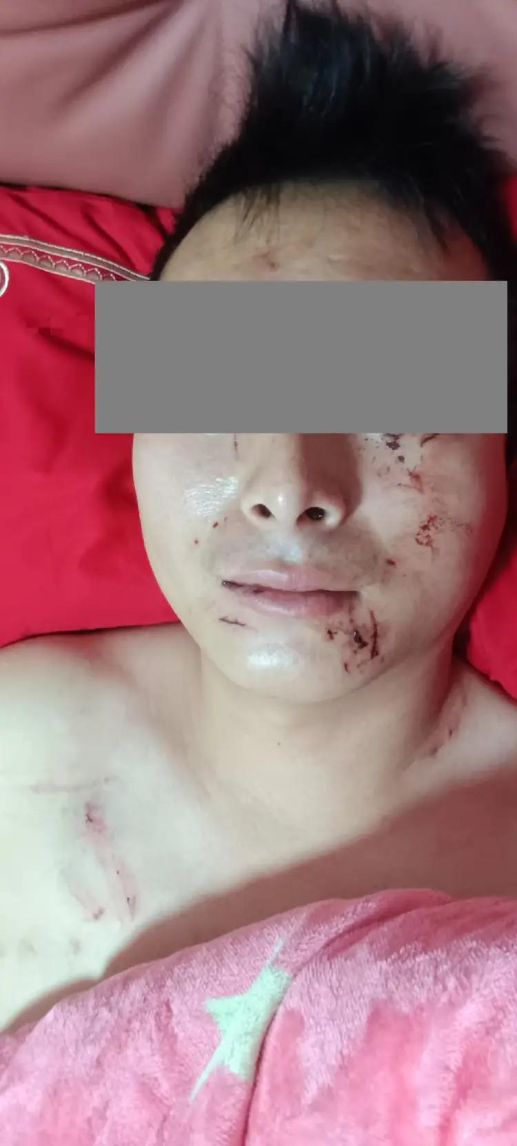 四川达州，男子在新婚夜被妻子抓得满脸流血。为了给她家面子，男子谎称自己是被摔伤的