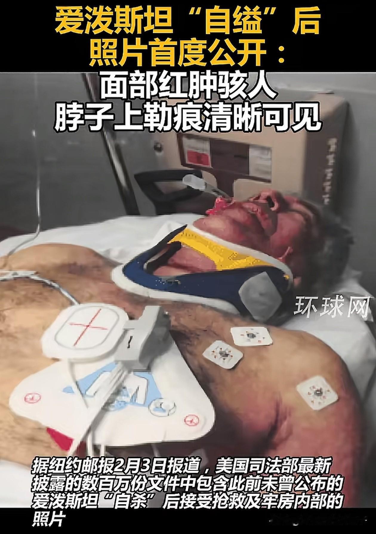 爱泼斯坦案件又曝光一张新照片，照片中爱泼斯坦脸部充血红肿的很厉害，嘴唇有咬破出血