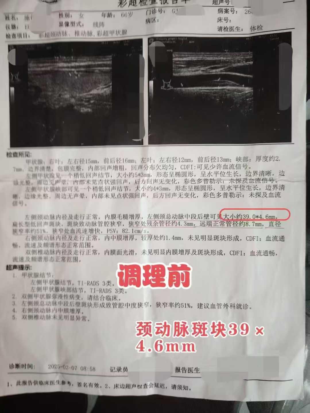 颈动脉斑块从39×4.6mm缩小至24.7×3.1mm！中药远远被低估了