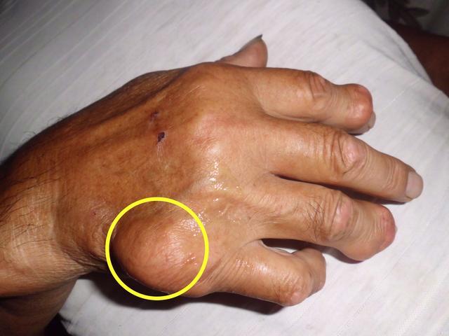 痛风最怕6件事, 第2个打死也不要碰!