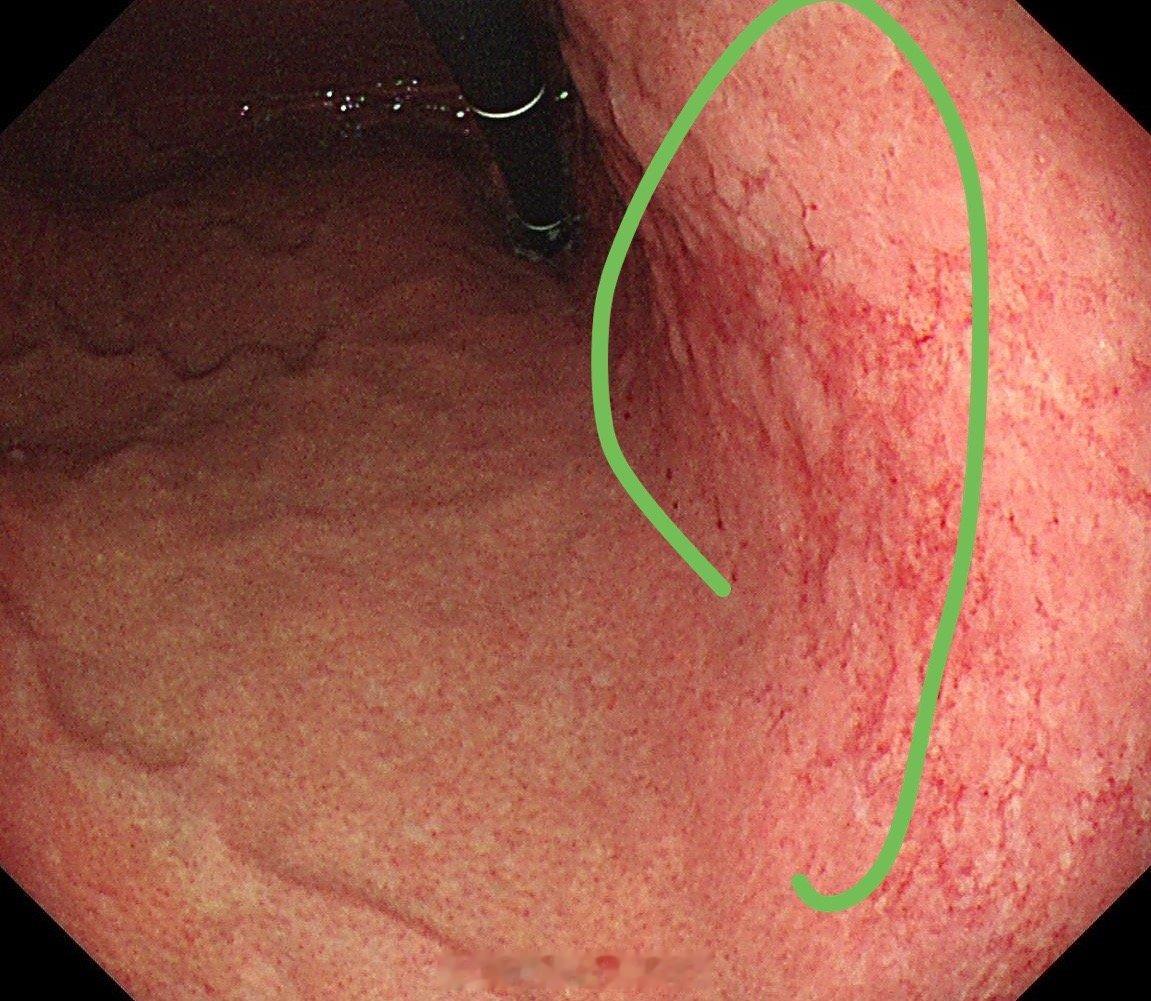 图示的这个胃体发红，在内镜下描述就是地图样发红，提示第一除菌成功，第二是风险人群