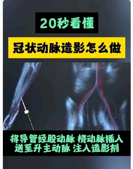 心脏造影到底伤不伤身体？专家几句话说透，99%的人都该看看！“心脏造影会有生