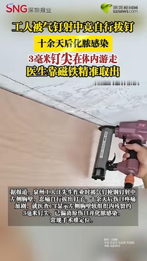 “真是个狠人！”5月12日报道，福建泉州，一男子干活时被气钉枪击中，气钉射进了左