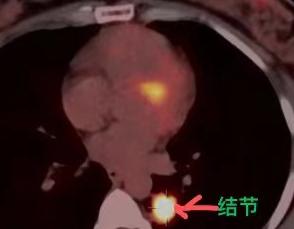 不少人都有一个固有误区：觉得肺结节、肺癌只会找上常年抽烟的人和老年人，年轻人、不