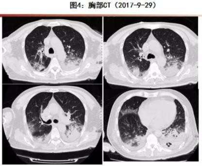 先搞清楚：流感不是普通感冒！最近好多人把流感当成重感冒扛，真的要不得！普通感