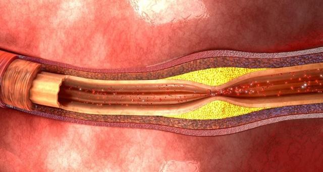 低密度脂蛋白要低于多少, 斑块才能不发展? 医生告诉你答案