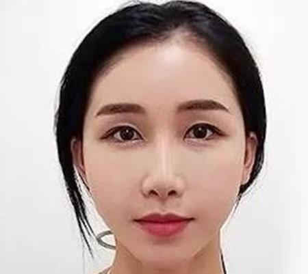 玻尿酸隆鼻后拍照不管远近都是好看