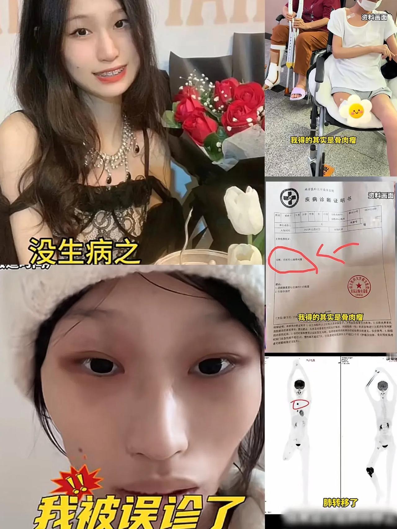 21岁的抗癌美女饭饭在与淋巴瘤、骨肉瘤的顽强搏斗后，于2025年9月14日离世