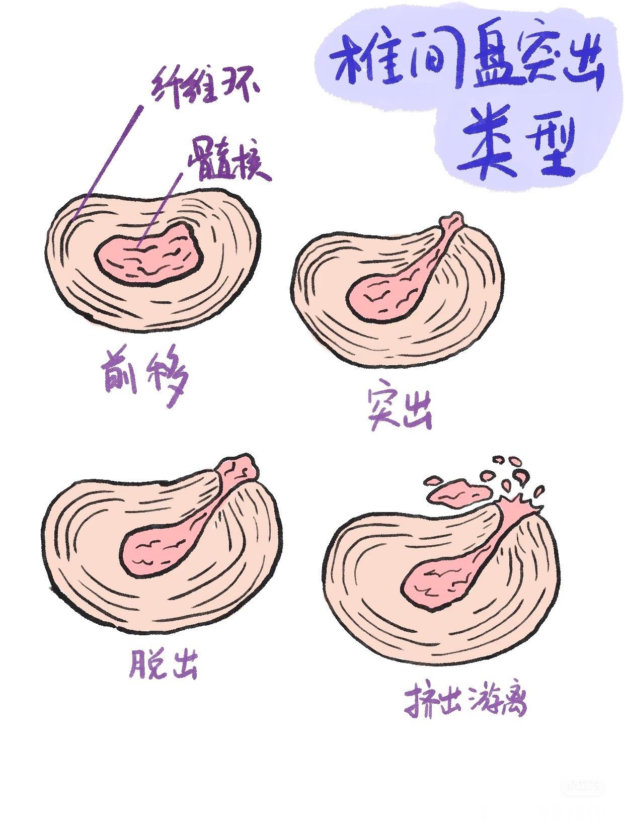 腰椎间盘突出来看不同的腰突类型——👉膨出型:椎间盘整体向外膨胀,但未破裂。?