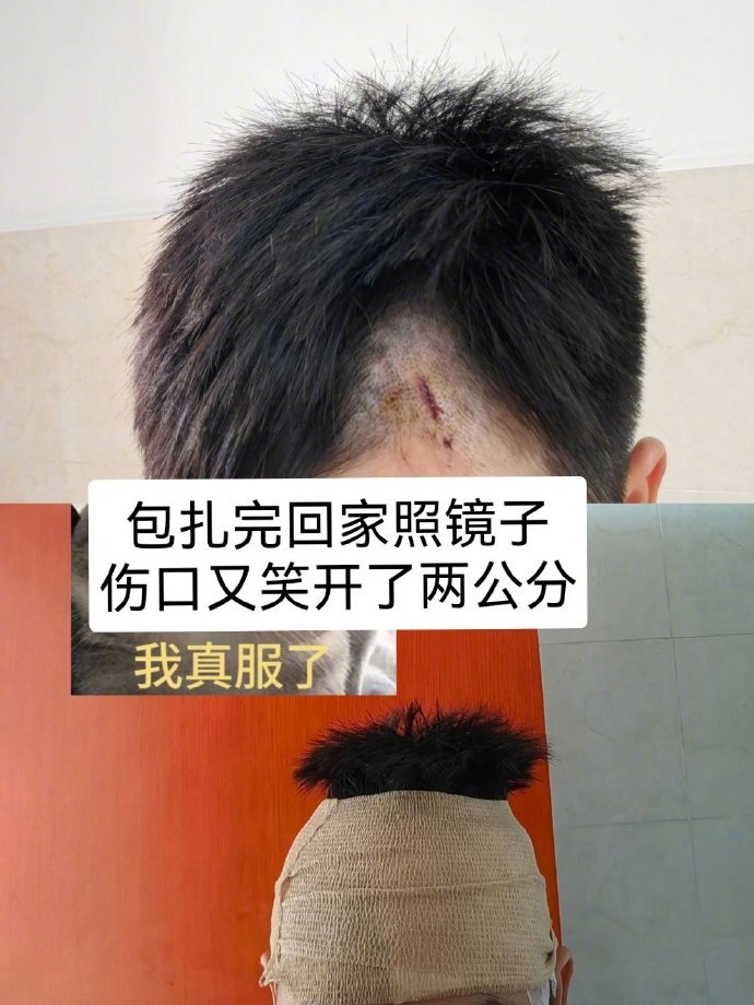 不建议在包扎后照镜子