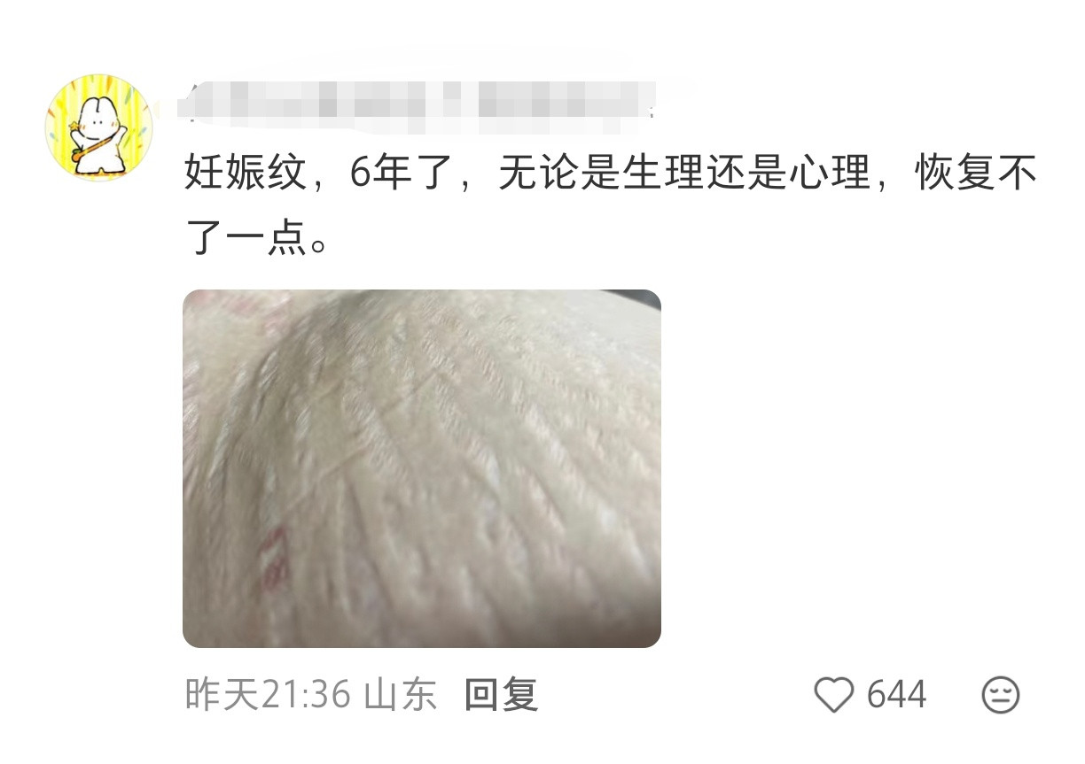 无意间找到了最像妊娠纹和生育后阴部撕裂的纹路之物​​​