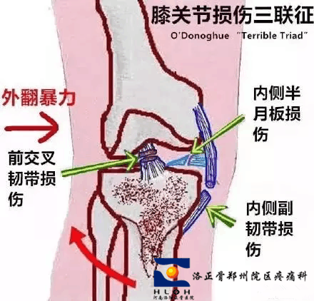 “膝关节损伤三联征”是个什么鬼? 咋预防?