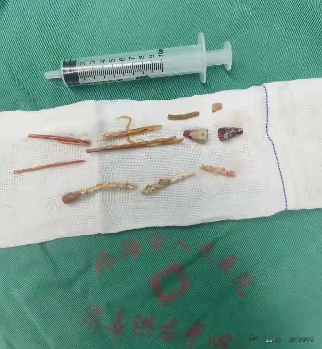 近日看到一则奇闻，广东一男子因肾结石合并肾脏脓肿到北海市人民医院就诊，结果医生意