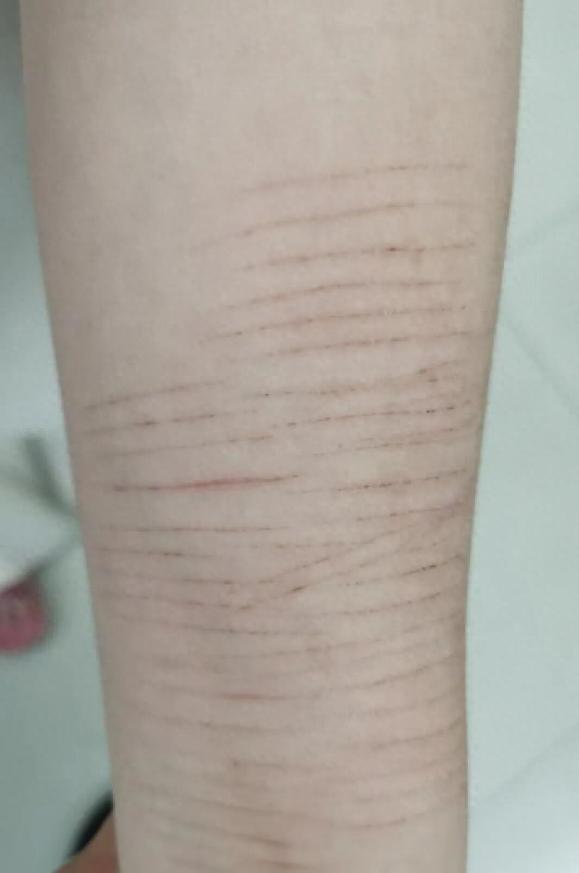 4月24日，郑州14岁女生胳膊上满是划痕，老师坚持让家长带去看病，家长却说“她能