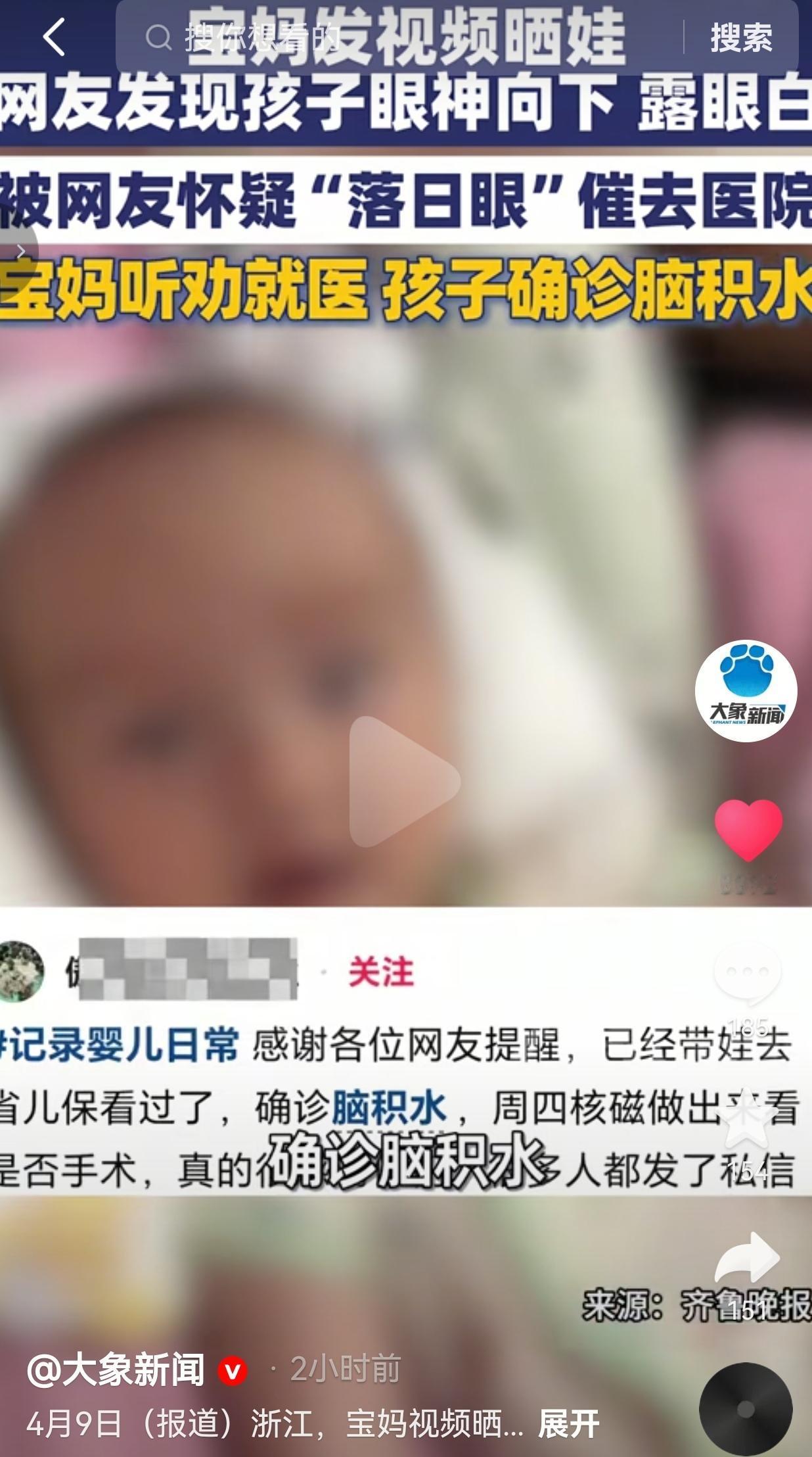 这次网友上大分！浙江一位宝妈发宝宝玩耍视频，被网友揪出“落日眼”异常，催着去大医
