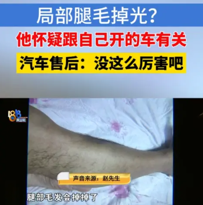 浙江诸暨，男子开新能源车1年，突然发现自己两条腿上原本茂密的毛发，竟然都掉秃了，