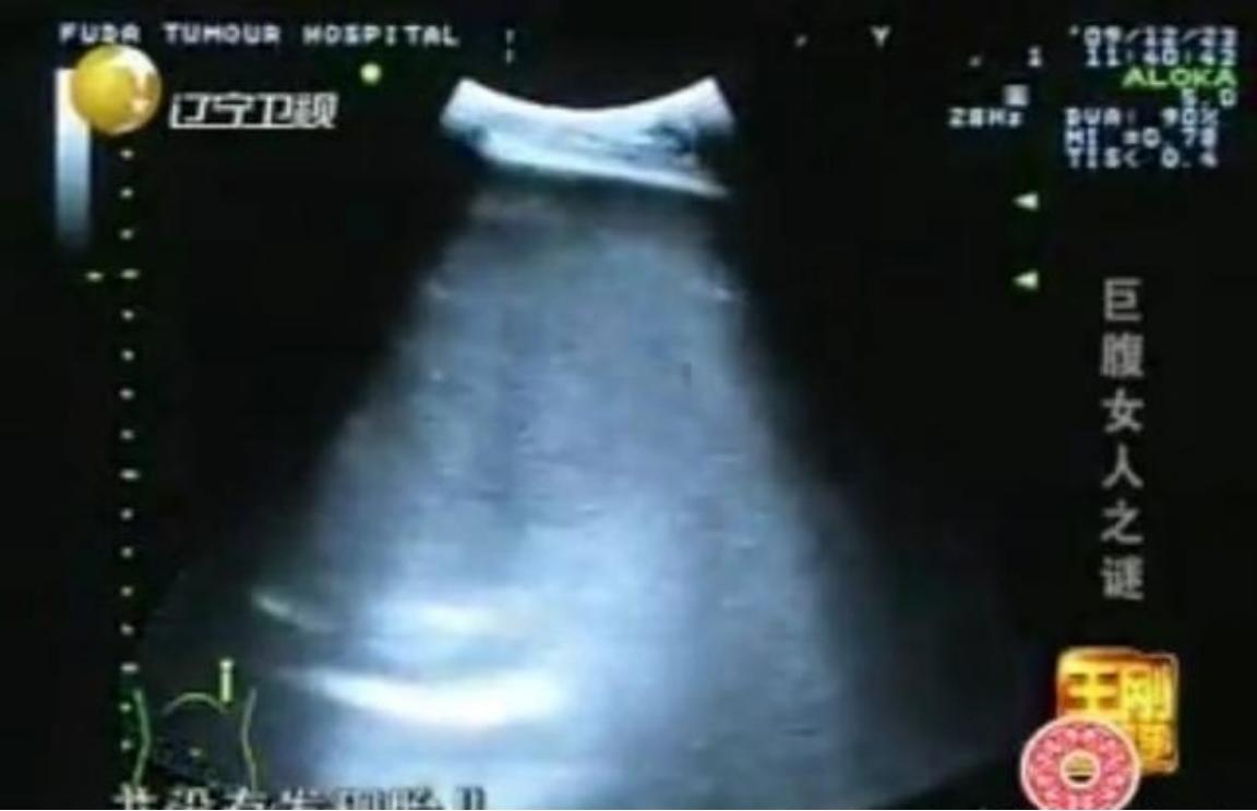 2009年，怀胎12个月的女人，在丈夫的陪同下，挺着巨肚，来到了广州医院检查，没