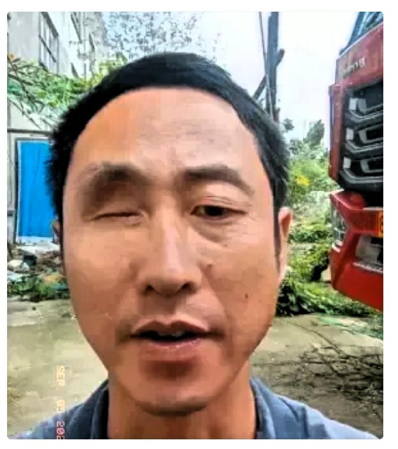 一只眼睛没了，去办残疾证，被告知另一只眼睛视力尚可，达不到评定标准。转头去驾