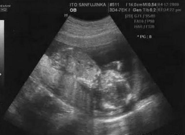 苦命产妇生宝宝, 没想到孩子出来个胳膊却被医生塞回去, 最终母子丧生让人心痛