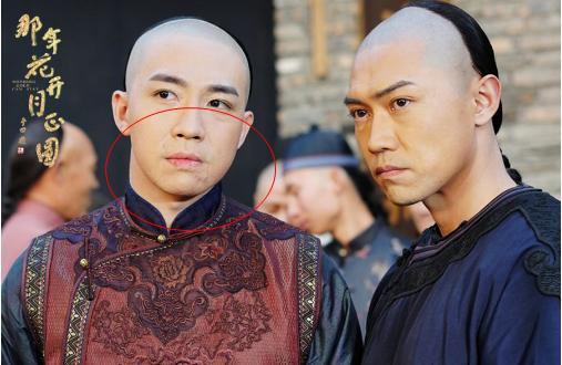 俞灏明烧伤前后对比