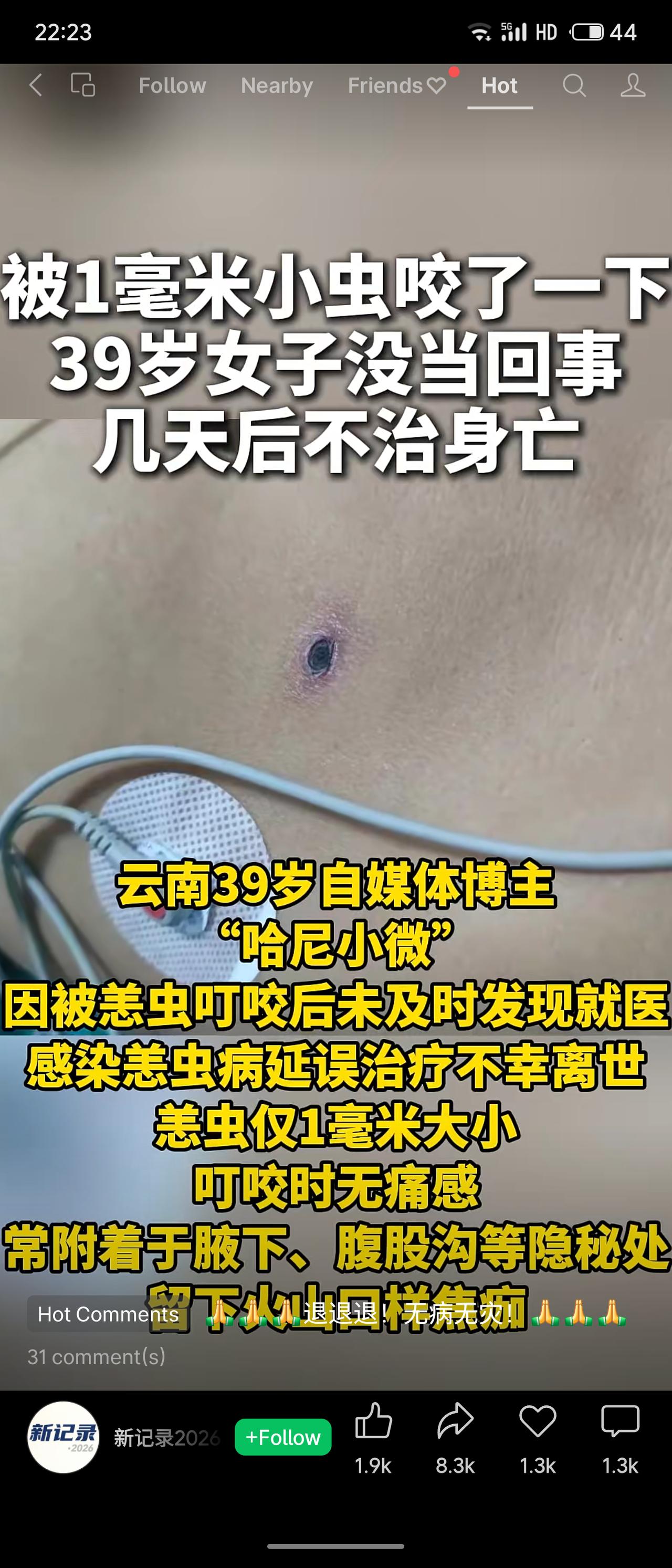 云南39岁自媒体博主“哈尼小微”被1毫米恙虫叮咬，未及时就医，数日后不治身亡。恙