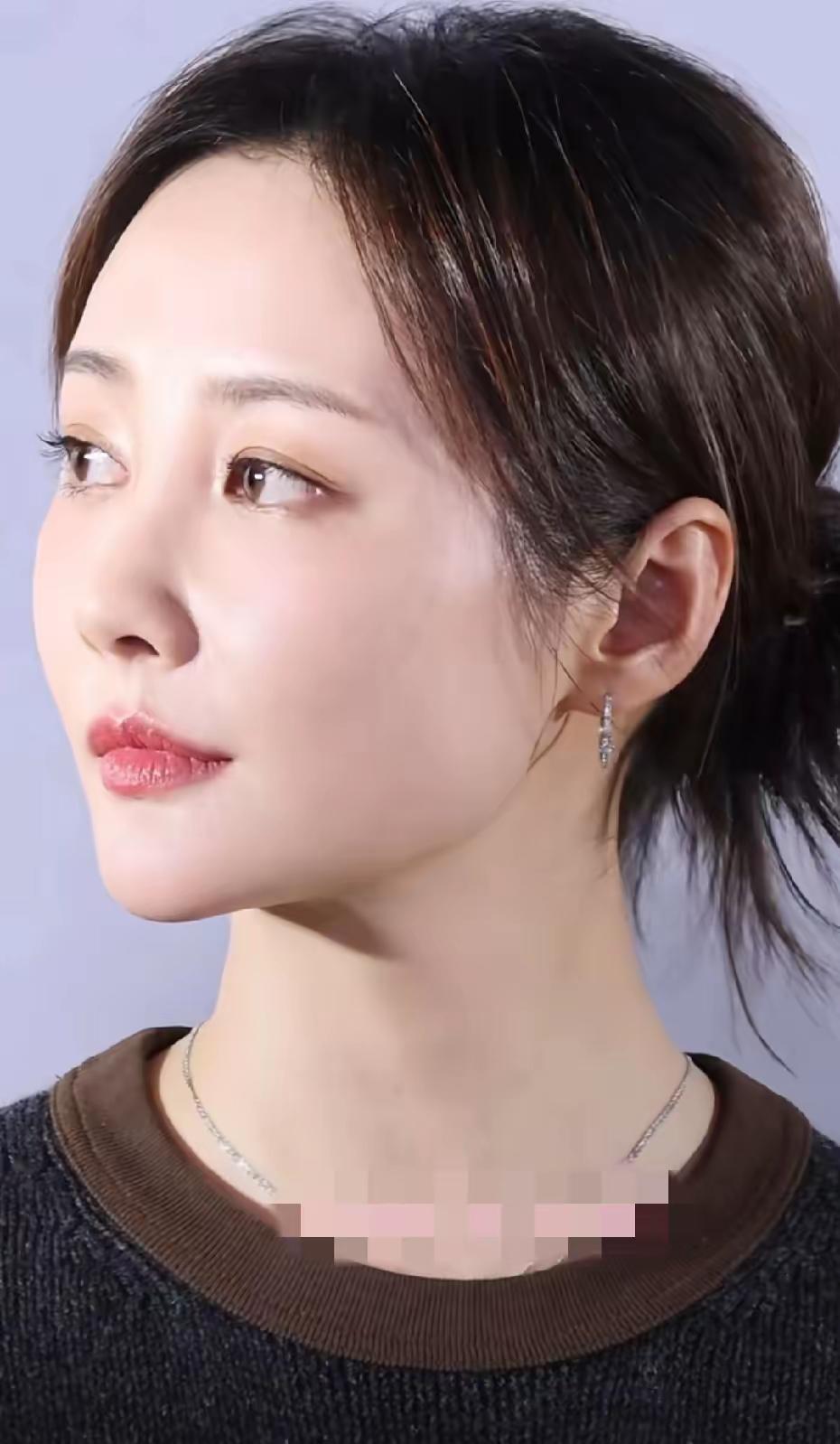 李纯做了填充，法令纹木偶纹泪沟颞区都做了填充，所以脸部变得饱满了。去看下她