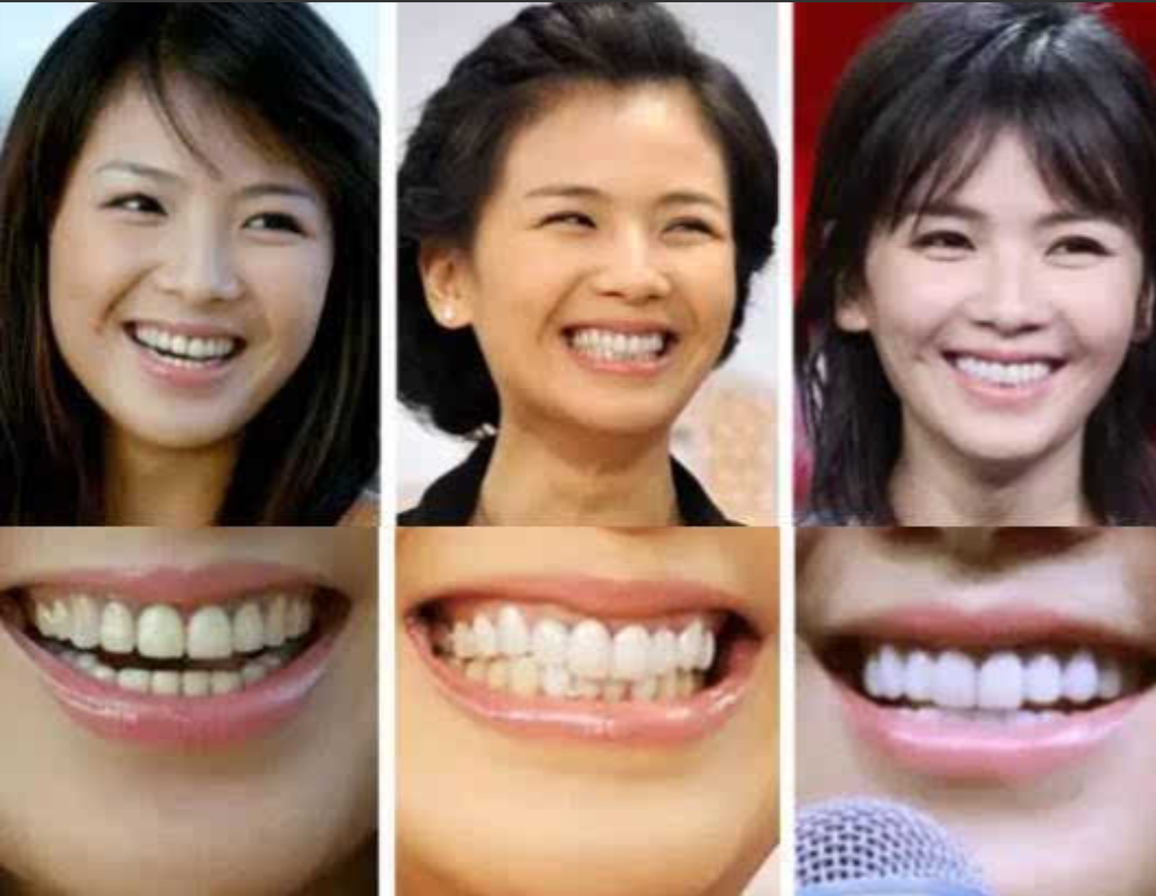 2016年，在录制《跨界歌王》时，刘涛突然牙疼，一旁的助理连忙说：“赶紧去医院，