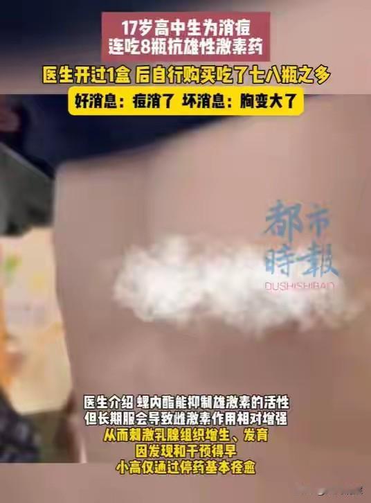 杭州17岁的男生小高，因为脸上长痘痘这事愁坏了，总觉得痘痘影响颜值，一心想快点消