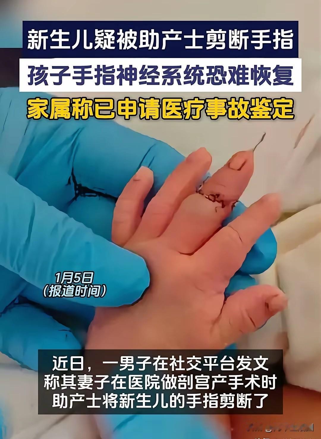 新生儿手指被剪断，这样的事真就发生在了人民医院，这里面一定有院方的管理问题。