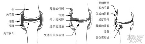 运动过度等,也会一点一点地磨损你的膝盖软骨,造成髌骨老化,骨关节炎