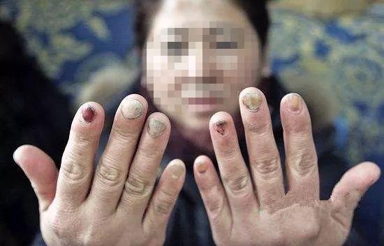 吴女士疼痛难忍,看了医生后才得知,自己的指甲被细菌感染伤,导致需要