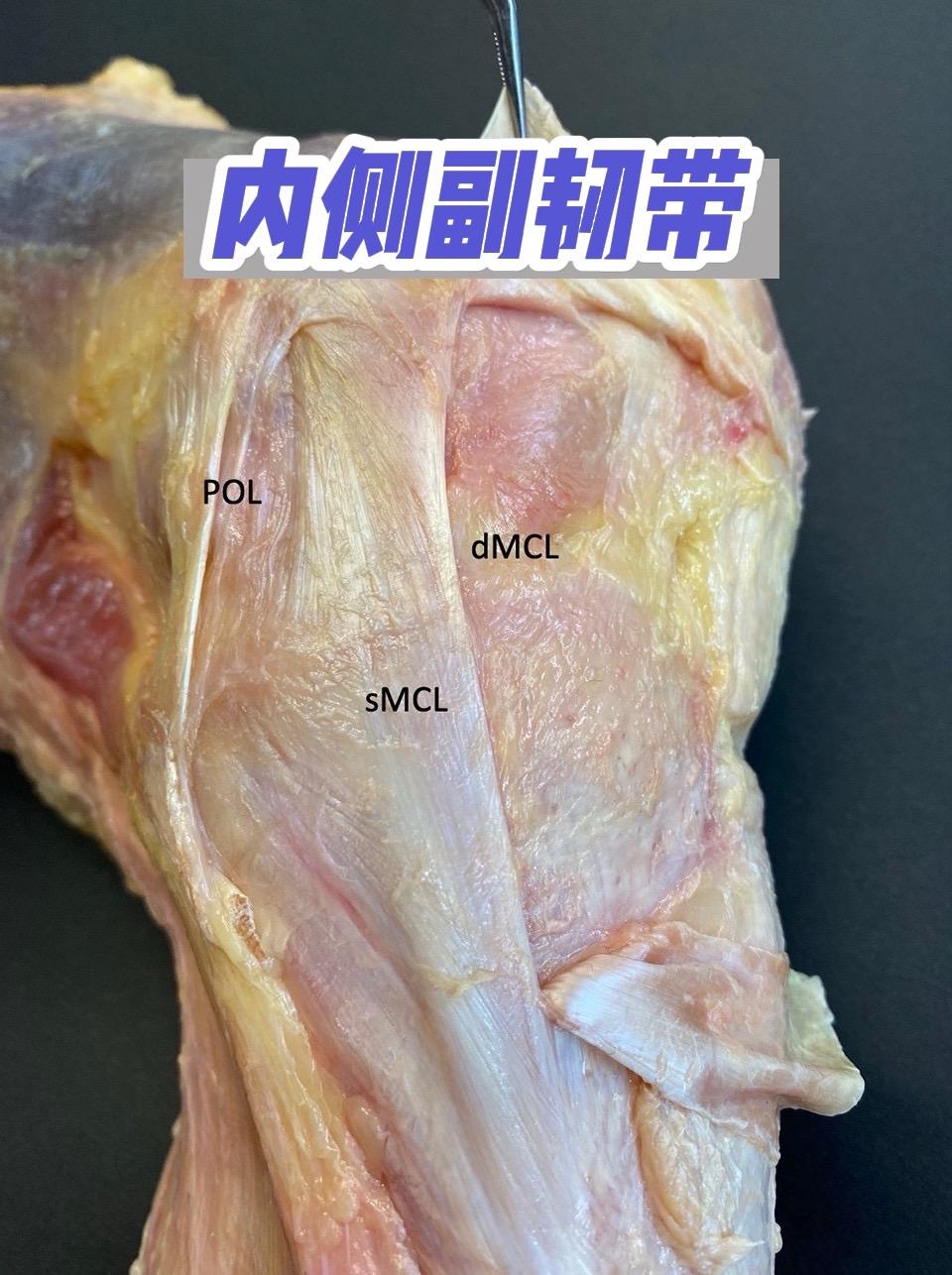 看懂【内侧副韧带】内侧副韧带，膝关节内侧稳定的核心。抵抗膝关节外翻应力...