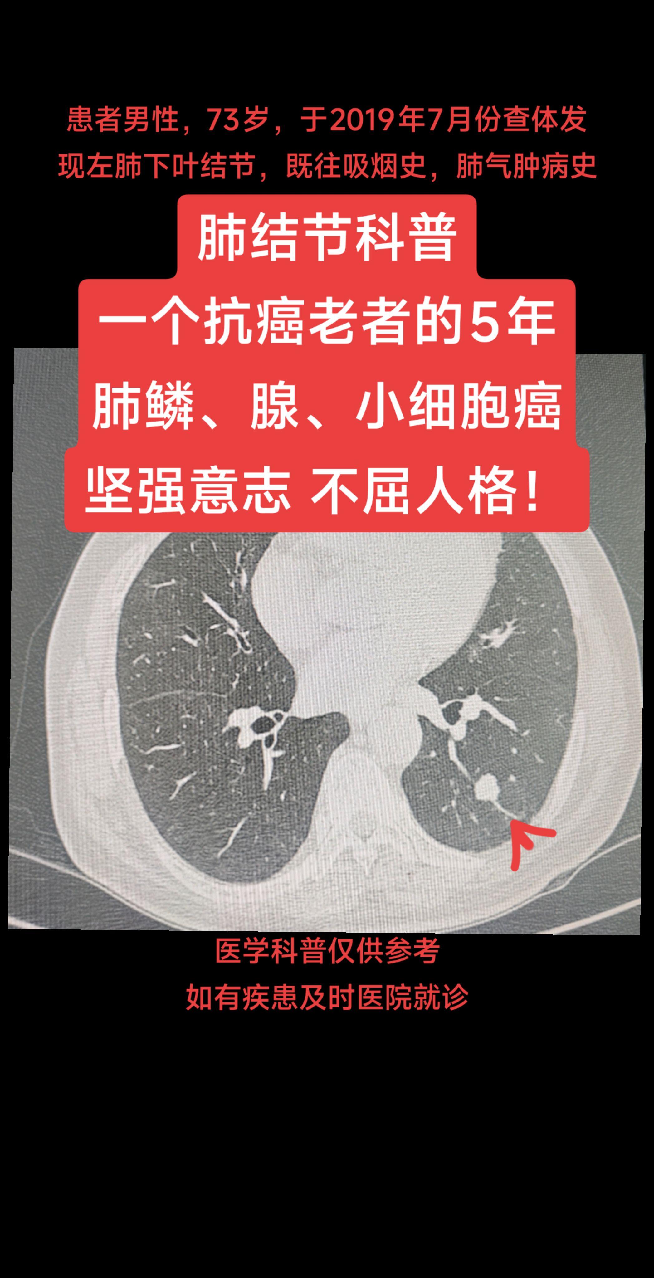肺结节科普肺腺癌一位抗癌老者的5年，先后罹患肺鳞癌、肺腺癌、肺小细胞神...
