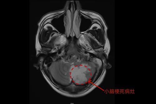 果然AI替代不了人类！湖南长沙，一名52岁的中年男子，在家中突发头晕，以为只是普