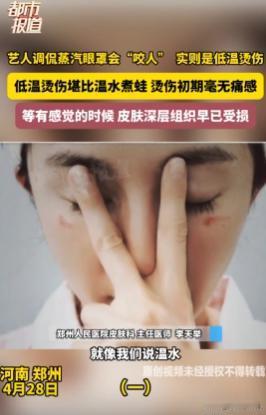 4月27日，当红演员杨幂在社交平台晒出被蒸汽眼罩烫伤的眼部照片，配文“蒸汽眼罩咬