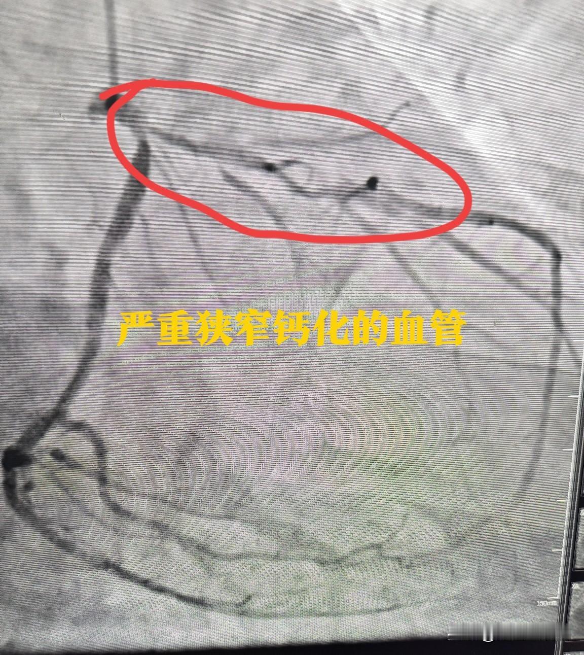 80岁老人心脏支架手术中突发胸痛，一台风险又高又惊险的手术。80岁老张平常没
