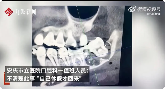 庸医害人啊！女子去医院拔智齿，医生拔错了，拔成原生牙齿，并且装在女子智齿上。这