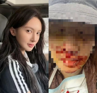 我问整形的朋友，金晨撞得满脸是血，为什么不去绍兴医院，还要去上海医院啊？​没想