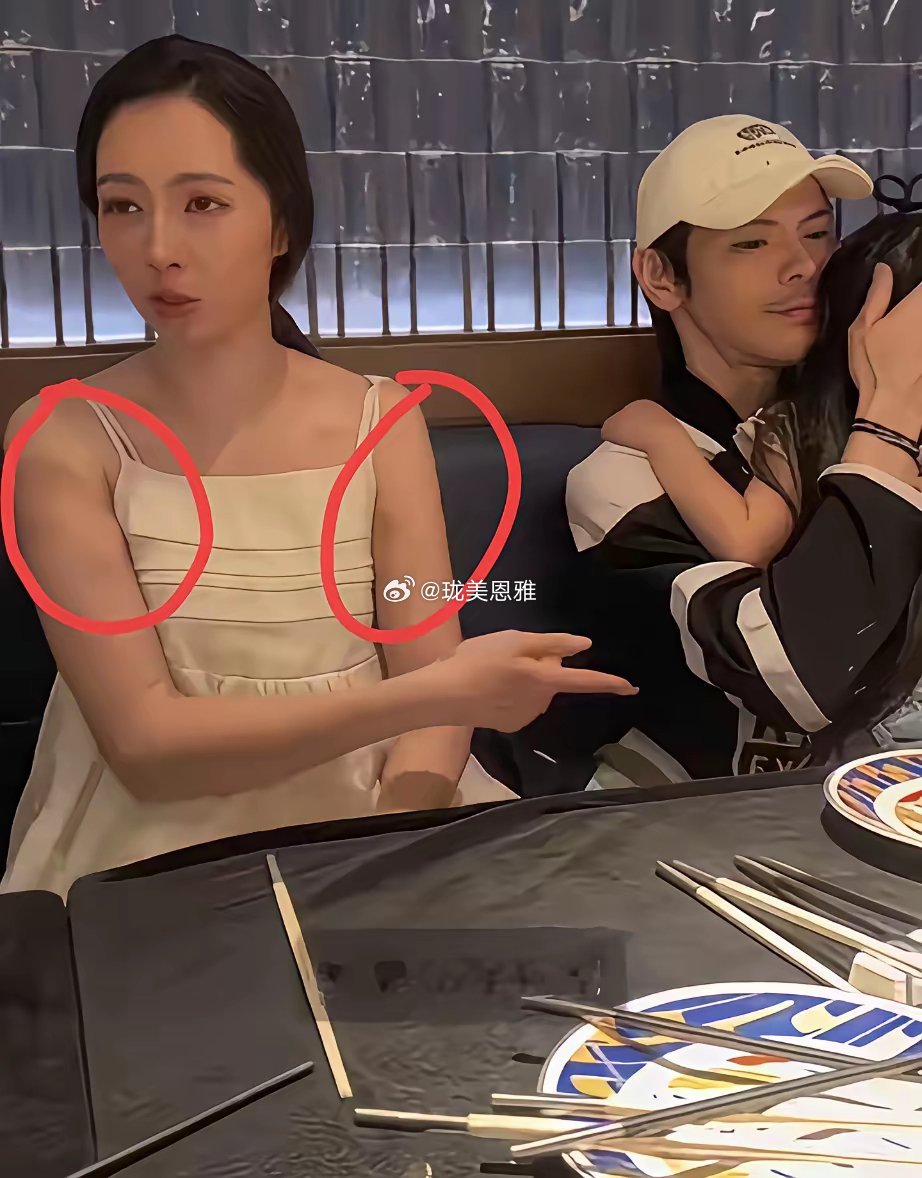 郭碧婷的手上怎么那么多淤青啊？