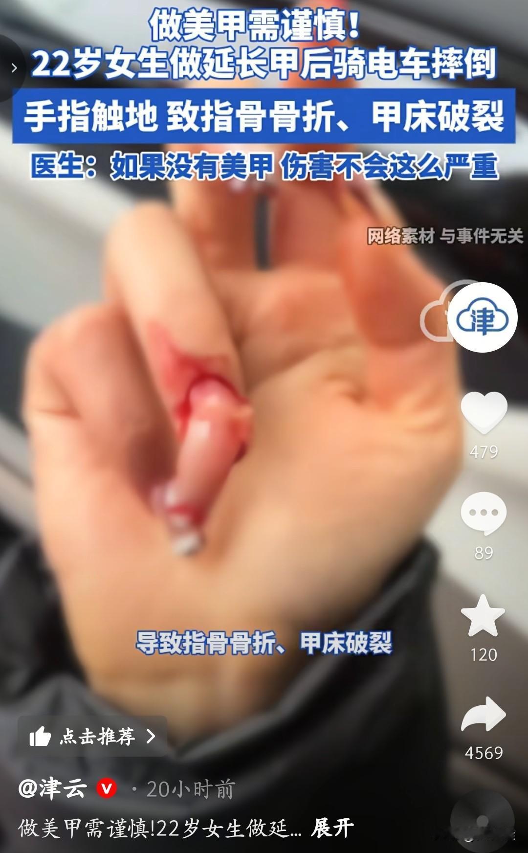 看得头皮发麻！做美甲竟让22岁女生摔成骨折！这画面看着都疼！一位22岁女生