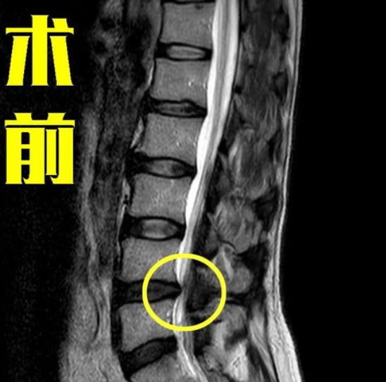 腰椎间盘突出，必须手术吗?  体检单上看到“腰椎间盘突出”这几个字，很多人